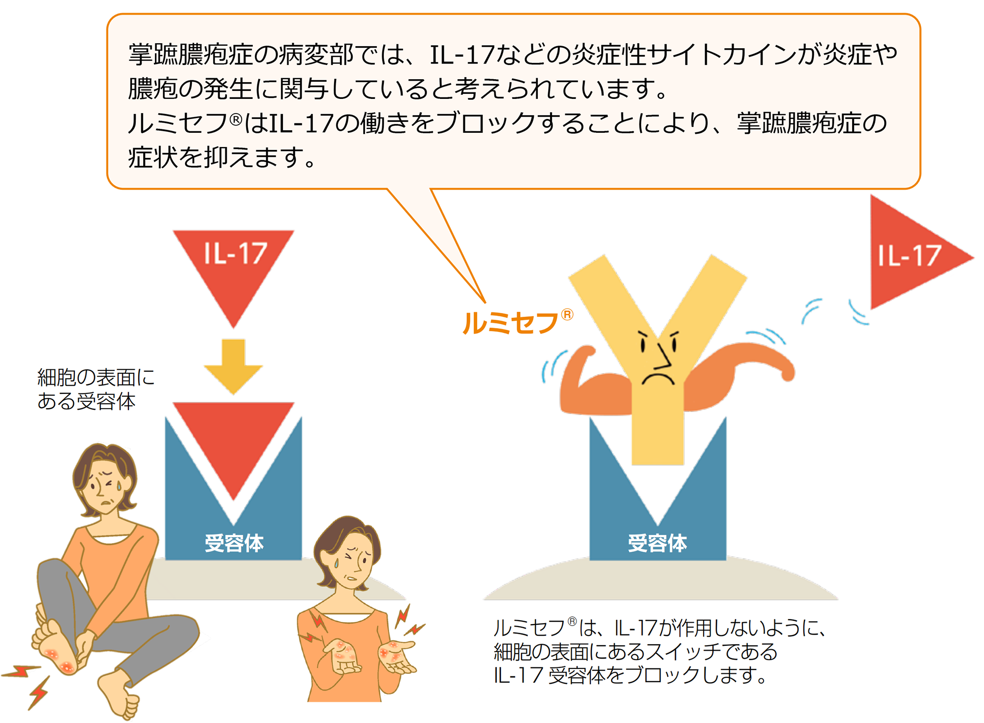 IL-17の働きをブロックすることにより、掌蹠膿疱症の症状を抑えます。