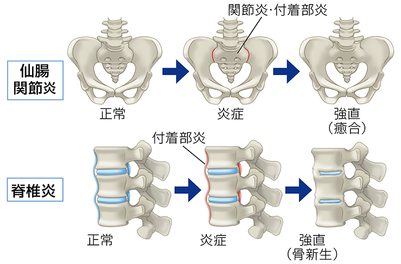 炎症から強直へ